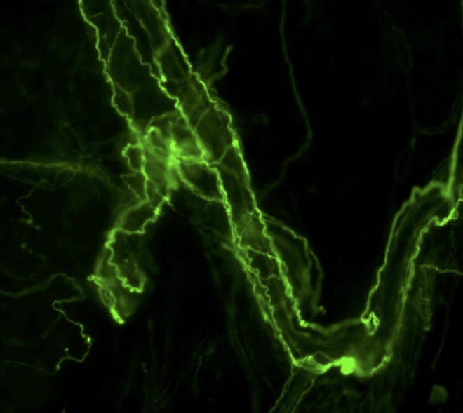 TRPV1 Channels in Stress-induced Bladder Dysfunction in Children